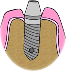 implant6