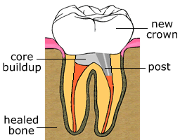 rct5