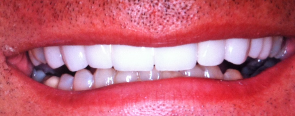 the space in between teeth feel sensitive the space in between teeth feel sensitive
